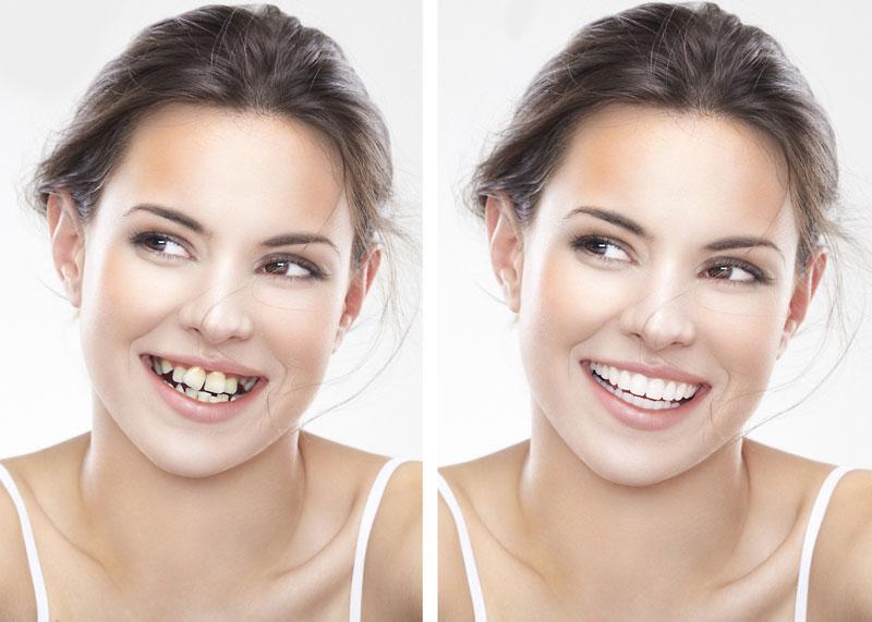 Bảng giá Niềng Răng Bảng giá Niềng Răng
